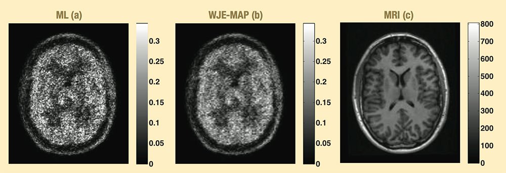 The brain PET image from a patient radiotracer (11C-DPA-713) study reconstructed using (a) the conventional reconstruction method and (b) the newly developed reconstruction method incorporating the anatomical information from (c) the corresponding MR image. The new method demonstrates its potential in clinical quantitative PET imaging. 11C-DPA-713 is a promising radiotracer for evaluating translocator protein (TSPO) binding with PET. TSPO can serve as a marker of neuro-inflammation. 